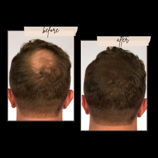 Toppik Before and after Mens